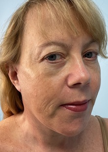Chin Augmentation After Photo by Julia Spears, MD, FACS; ,  - Case 50706