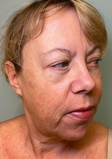 Chin Augmentation Before Photo by Julia Spears, MD, FACS; ,  - Case 50706