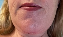 Chin Augmentation After Photo by Julia Spears, MD, FACS; ,  - Case 50706