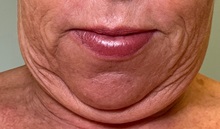 Chin Augmentation Before Photo by Julia Spears, MD, FACS; ,  - Case 50706