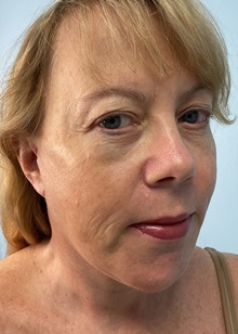 Facelift After Photo by Julia Spears, MD, FACS; ,  - Case 50707