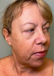 Facelift Before Photo by Julia Spears, MD, FACS; ,  - Case 50707