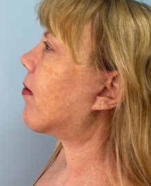 Facelift After Photo by Julia Spears, MD, FACS; ,  - Case 50707