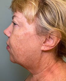 Facelift Before Photo by Julia Spears, MD, FACS; ,  - Case 50707