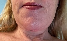 Facelift After Photo by Julia Spears, MD, FACS; ,  - Case 50707