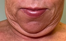 Facelift Before Photo by Julia Spears, MD, FACS; ,  - Case 50707