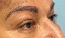 Eyelid Surgery After Photo by Julia Spears, MD, FACS; ,  - Case 50709