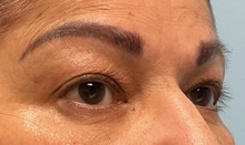 Eyelid Surgery Before Photo by Julia Spears, MD, FACS; ,  - Case 50709