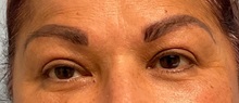 Eyelid Surgery After Photo by Julia Spears, MD, FACS; ,  - Case 50709