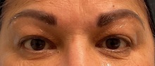 Eyelid Surgery Before Photo by Julia Spears, MD, FACS; ,  - Case 50709