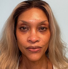 Eyelid Surgery After Photo by Julia Spears, MD, FACS; ,  - Case 50711