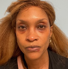 Eyelid Surgery Before Photo by Julia Spears, MD, FACS; ,  - Case 50711