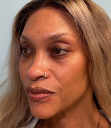 Eyelid Surgery After Photo by Julia Spears, MD, FACS; ,  - Case 50711