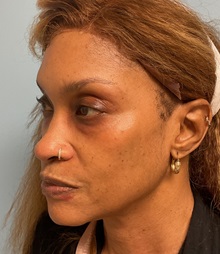 Eyelid Surgery Before Photo by Julia Spears, MD, FACS; ,  - Case 50711