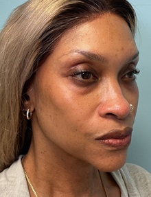 Eyelid Surgery After Photo by Julia Spears, MD, FACS; ,  - Case 50711