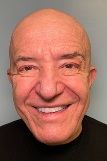 Facelift After Photo by Julia Spears, MD, FACS; ,  - Case 50712