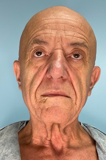 Facelift Before Photo by Julia Spears, MD, FACS; ,  - Case 50712