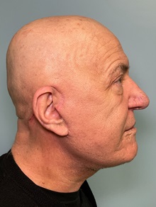 Facelift After Photo by Julia Spears, MD, FACS; ,  - Case 50712