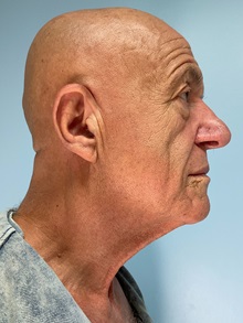 Facelift Before Photo by Julia Spears, MD, FACS; ,  - Case 50712