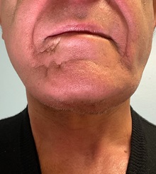 Neck Lift After Photo by Julia Spears, MD, FACS; ,  - Case 50713