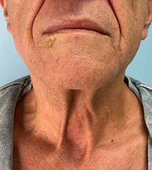 Neck Lift Before Photo by Julia Spears, MD, FACS; ,  - Case 50713