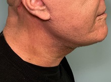 Neck Lift After Photo by Julia Spears, MD, FACS; ,  - Case 50713