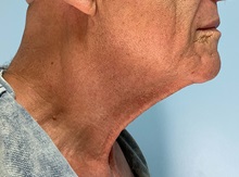 Neck Lift Before Photo by Julia Spears, MD, FACS; ,  - Case 50713