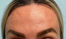 Botulinum Toxin After Photo by Julia Spears, MD, FACS; ,  - Case 50720