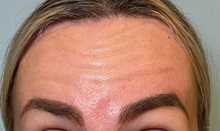 Botulinum Toxin Before Photo by Julia Spears, MD, FACS; ,  - Case 50720