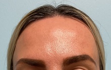 Botulinum Toxin After Photo by Julia Spears, MD, FACS; ,  - Case 50720