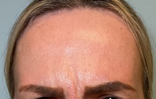 Botulinum Toxin Before Photo by Julia Spears, MD, FACS; ,  - Case 50720