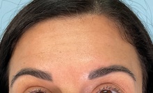 Botulinum Toxin After Photo by Julia Spears, MD, FACS; ,  - Case 50721