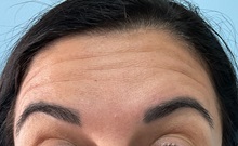 Botulinum Toxin Before Photo by Julia Spears, MD, FACS; ,  - Case 50721