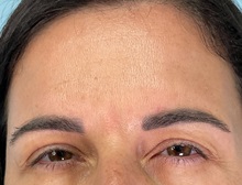 Botulinum Toxin After Photo by Julia Spears, MD, FACS; ,  - Case 50721