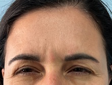 Botulinum Toxin Before Photo by Julia Spears, MD, FACS; ,  - Case 50721