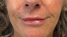 Lip Augmentation/Enhancement After Photo by Julia Spears, MD, FACS; ,  - Case 50722