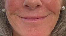 Lip Augmentation/Enhancement Before Photo by Julia Spears, MD, FACS; ,  - Case 50722