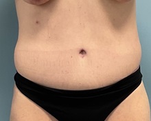 Liposuction After Photo by Julia Spears, MD, FACS; ,  - Case 50724