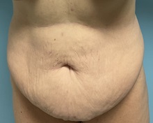 Liposuction Before Photo by Julia Spears, MD, FACS; ,  - Case 50724
