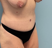 Liposuction After Photo by Julia Spears, MD, FACS; ,  - Case 50724