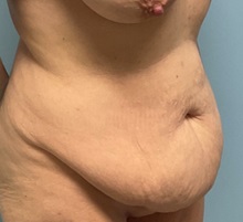 Liposuction Before Photo by Julia Spears, MD, FACS; ,  - Case 50724
