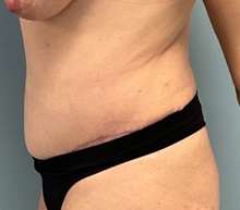 Liposuction After Photo by Julia Spears, MD, FACS; ,  - Case 50724