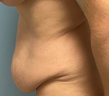 Liposuction Before Photo by Julia Spears, MD, FACS; ,  - Case 50724