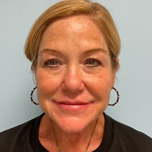 Dermal Fillers After Photo by Julia Spears, MD, FACS; ,  - Case 50726