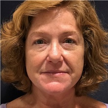 Dermal Fillers Before Photo by Julia Spears, MD, FACS; ,  - Case 50726