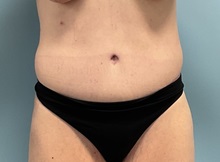Tummy Tuck After Photo by Julia Spears, MD, FACS; ,  - Case 50723