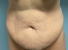 Tummy Tuck Before Photo by Julia Spears, MD, FACS; ,  - Case 50723
