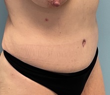 Tummy Tuck After Photo by Julia Spears, MD, FACS; ,  - Case 50723