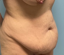 Tummy Tuck Before Photo by Julia Spears, MD, FACS; ,  - Case 50723