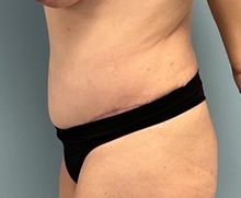 Tummy Tuck After Photo by Julia Spears, MD, FACS; ,  - Case 50723